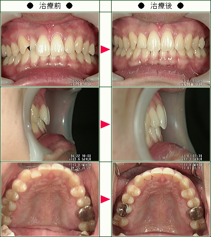 歯のデコボコ矯正症例(原田様　２６歳　男性)