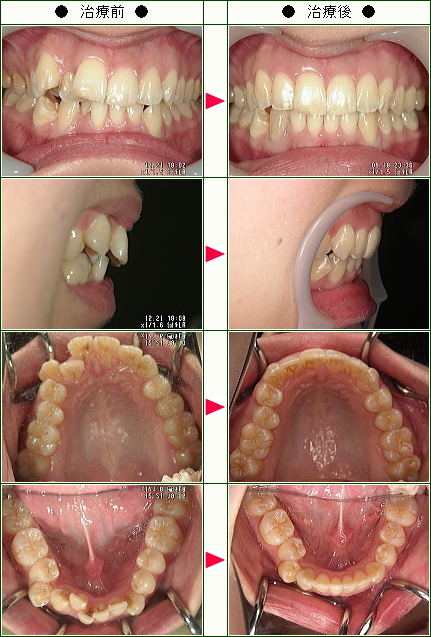 歯のデコボコ矯正症例(春山様　２１歳　女性)