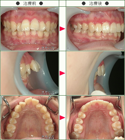 出っ歯矯正症例(長谷川様　２０歳　女性)