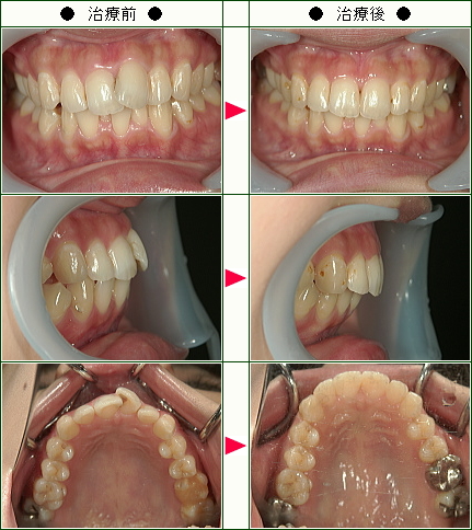 歯のデコボコ矯正症例(畑下様　２６歳　女性)