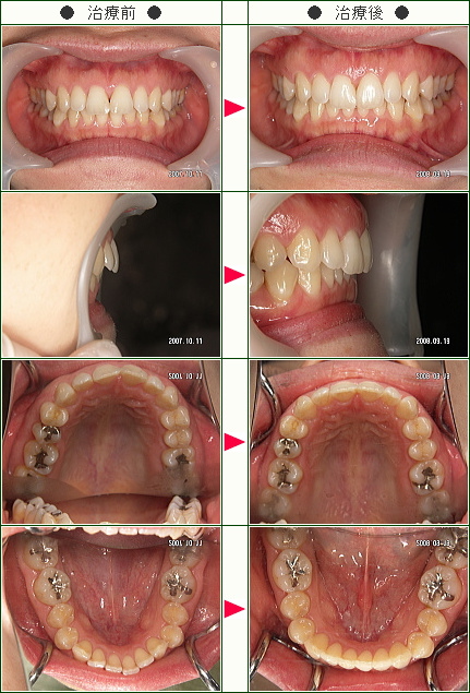 出っ歯矯正症例(ハットリ様　２９歳　女性)