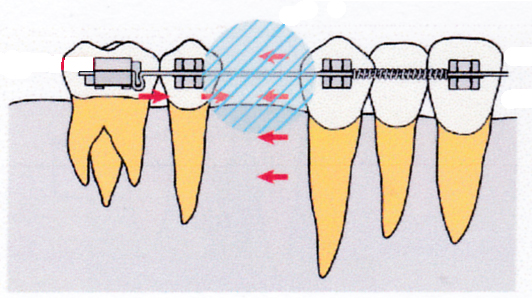 歯を抜いたスペースに歯体移動で動かす