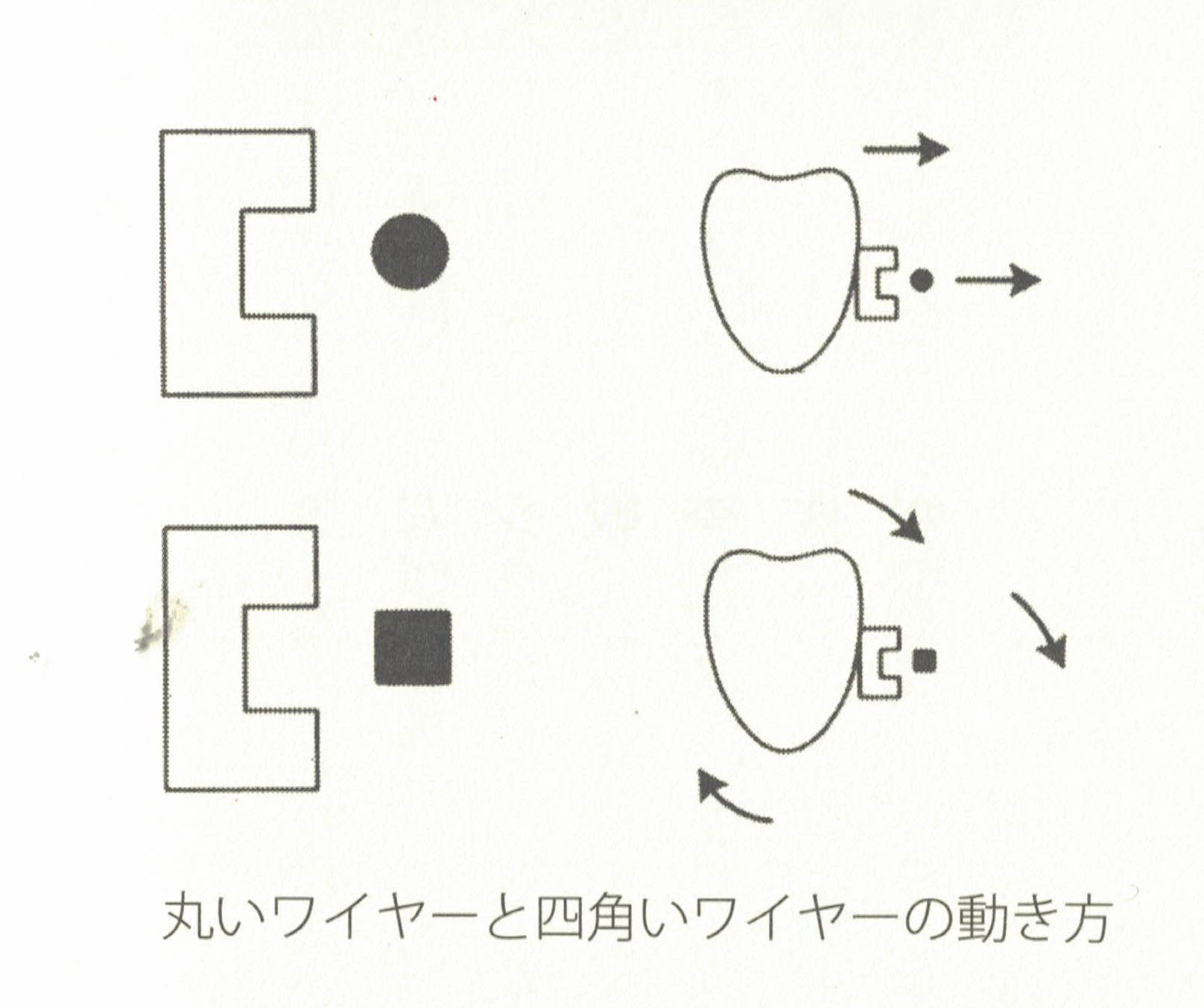 ワイヤーによる歯の動かし方