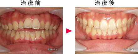開咬治療前後の症例1