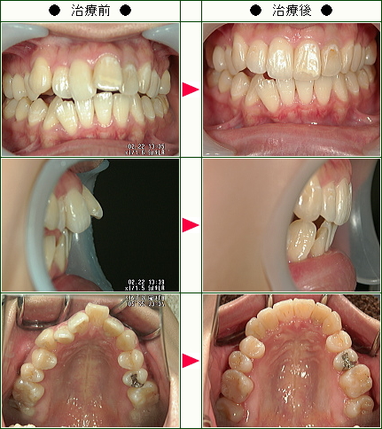 出っ歯矯正症例(Ｈ.Ｈ様　２４歳　女性)
