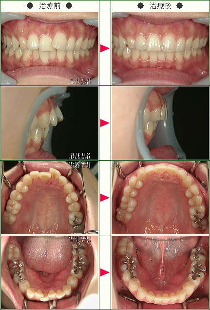 歯のデコボコ矯正症例(Ｈ．Ｈ様　３２歳　女性)