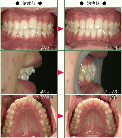 歯のデコボコ矯正症例(Ｈ・Ｉ様　２０歳　男性)