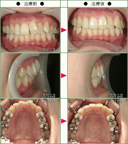 歯のデコボコ矯正症例(ＨＩ様　３３歳　女性)