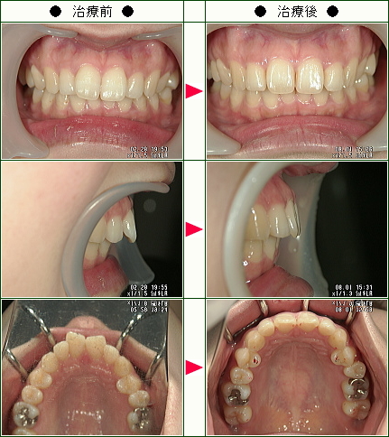 歯のデコボコ矯正症例(ひまわりんご様　２９歳　女性)