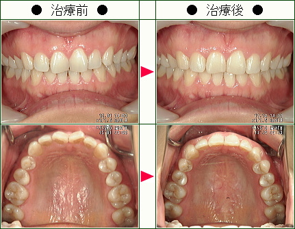 歯のデコボコ矯正症例(ひみこローズ様　３２歳　女性)