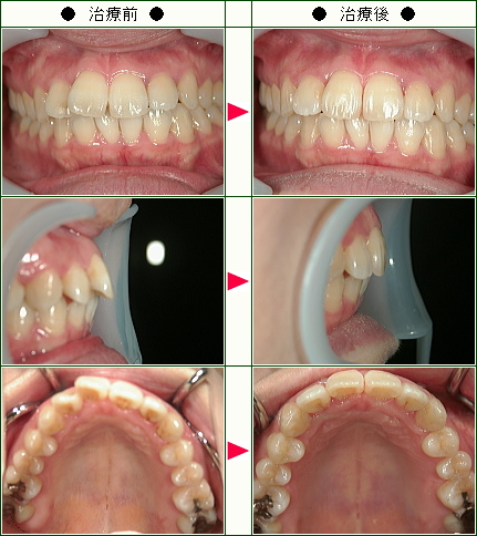 歯のデコボコ矯正症例(ヒラノ様　３８歳　女性)