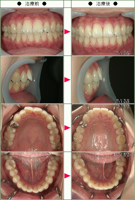 歯のデコボコ矯正症例(広原様　２９歳　女性)