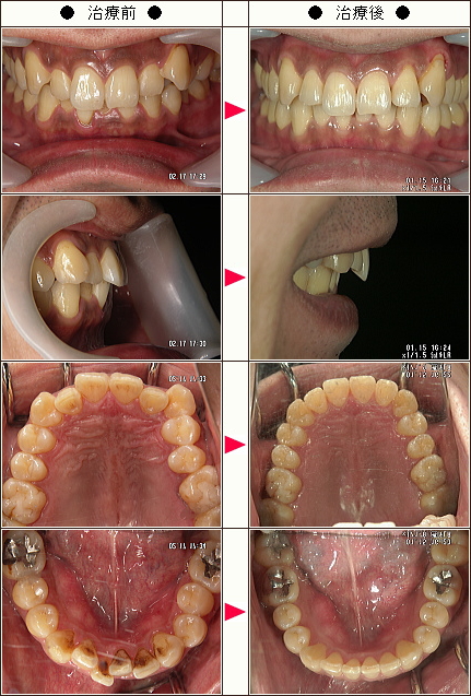 歯のデコボコ矯正症例［ヒロユキ様　３７歳　男性］