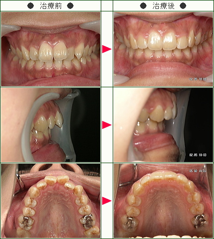歯のデコボコ矯正症例(ひさこ様　２５歳　女性)