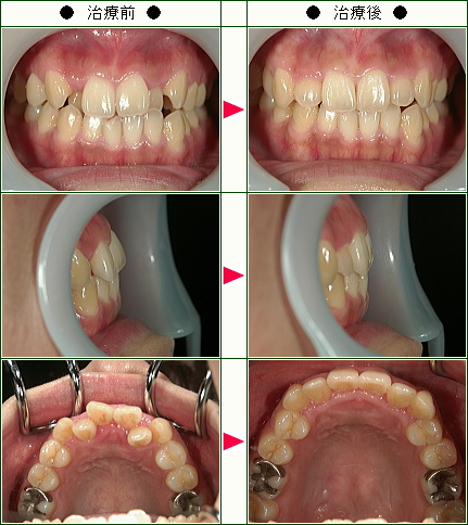 歯のデコボコ矯正症例(Ｈ．Ｋ様　２９歳　女性)