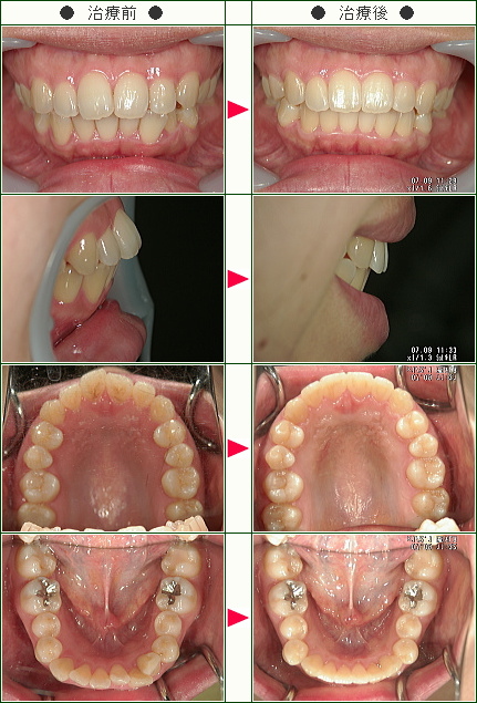 出っ歯矯正症例(Ｈ.Ｋ様　２９歳　女性)