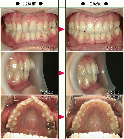 歯のデコボコ矯正症例(Ｈ・Ｋ様　３６歳　女性)