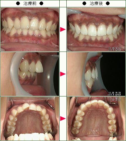 歯のデコボコ矯正症例(Ｈ．Ｍ様　２１歳　女性)