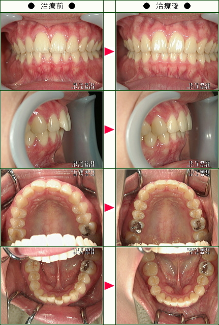 歯のデコボコ矯正症例(Ｈ.Ｍ様　２６歳　女性)