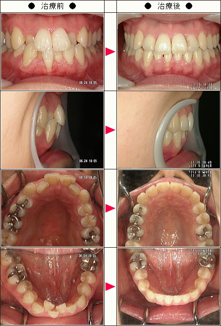 歯のデコボコ矯正症例［Ｈ・Ｍ様　３３歳　女性］