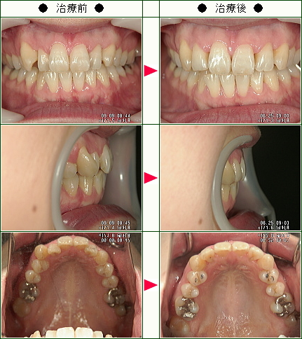歯のデコボコ矯正症例(Ｈ．Ｍ．様　３７歳　女性)