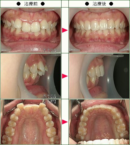 歯のデコボコ矯正症例(Ｈ．Ｎ様　２７歳　女性)