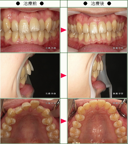 出っ歯矯正症例(Ｈ．Ｎ．様　２９歳　女性)