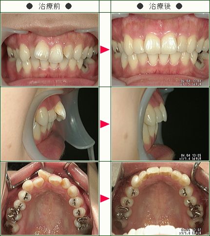 歯のデコボコ矯正症例(Ｈ・Ｏ様　３０歳　女性)