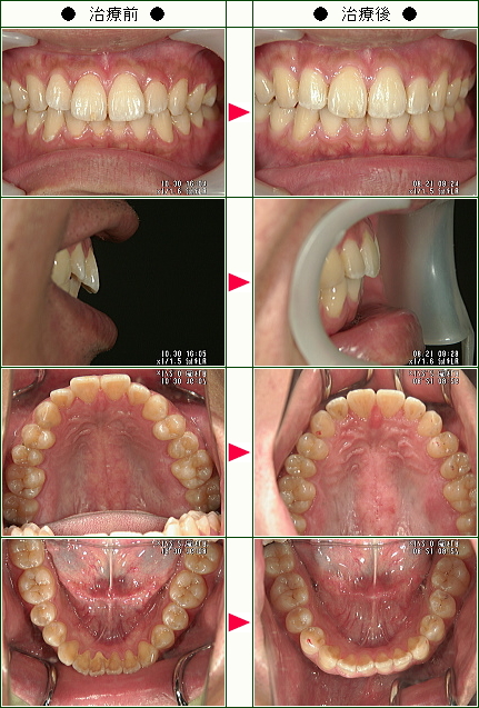 歯のデコボコ矯正症例(ホンダ様　２６歳　男性)