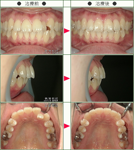 歯のデコボコ矯正症例(Ｈ.Ｓ様　２６歳　女性)