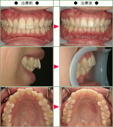 歯のデコボコ矯正症例(Ｈ.Ｓ様　３０歳　女性)