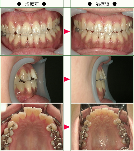歯のデコボコ矯正症例(Ｈ.Ｓ様　３７歳　女性)