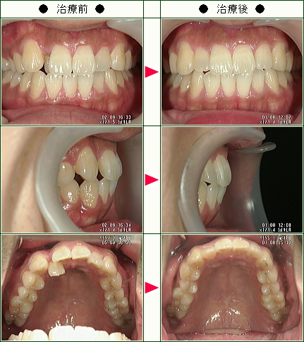 歯のデコボコ矯正症例(Ｈ・Ｔ様　２６歳　男性)