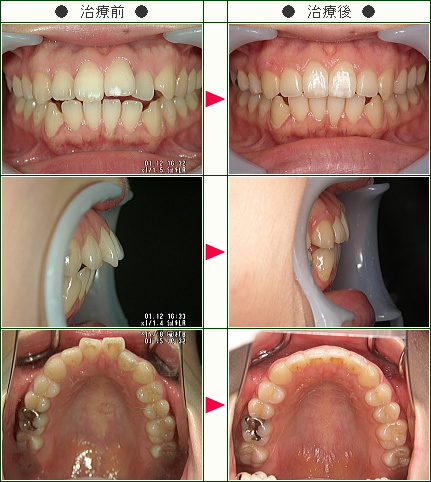 出っ歯矯正症例(Ｈ．Ｕ様　２８歳　女性)