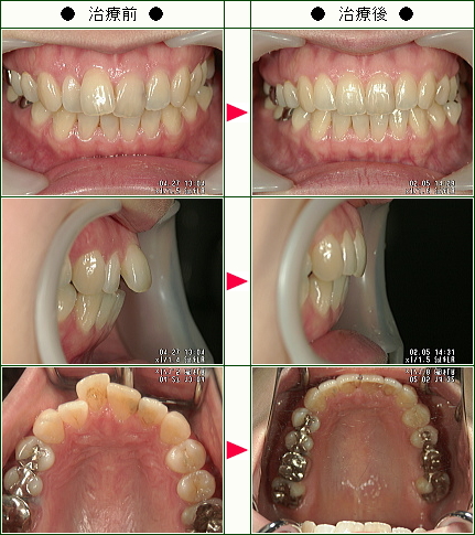 歯のデコボコ矯正症例(藤田様　３０歳　女性)