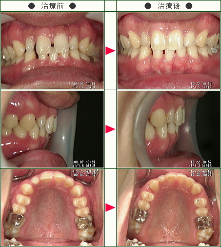 前歯のすきっ歯矯正症例(福地様　３０歳　男性)