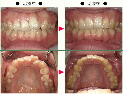 歯のデコボコ矯正症例(福田様　２７歳　女性)
