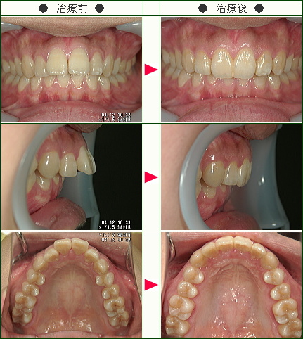 出っ歯矯正症例(古舘様　１９歳　女性)