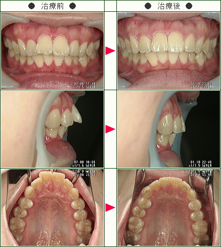 出っ歯矯正症例(Ｈ・Ｗ様　２２歳　女性)