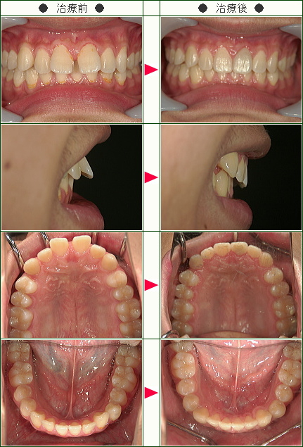前歯のすきっ歯矯正症例(Ｈ.Ｙ様　１９歳　男性)