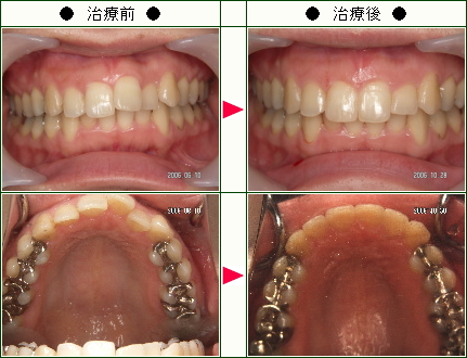 歯のデコボコ矯正症例(Ｈ・Ｙ様　２５歳　女性)