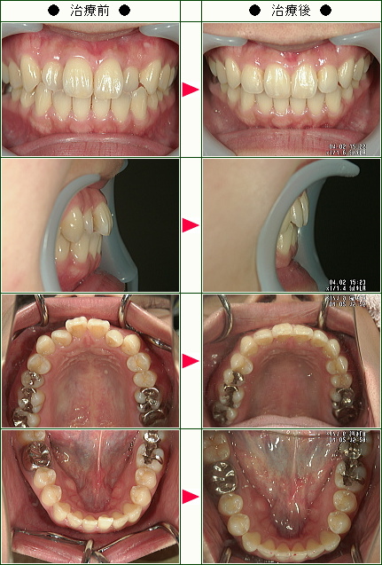 歯のデコボコ矯正症例(Ｈ.Ｙ様　２８歳　女性)