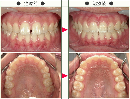 前歯のすきっ歯矯正症例(Ｉ様　１６歳　女性)