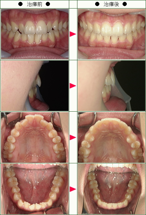 歯のデコボコ矯正症例(Ｉ様　２０歳　女性)