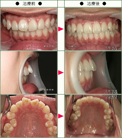 歯のデコボコ矯正症例(Ｉ様　２５歳　女性)
