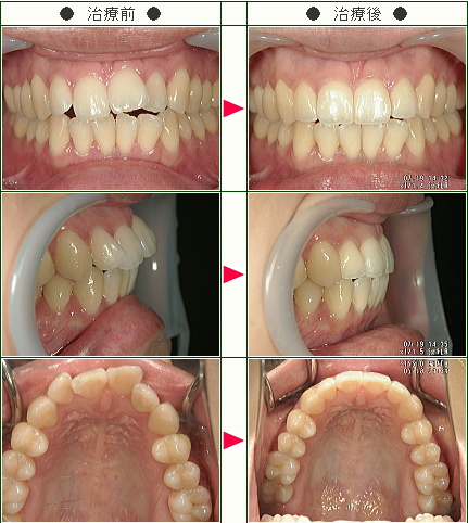 出っ歯矯正症例(Ｉ様　２６歳　女性)