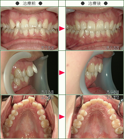 歯のデコボコ矯正症例(Ｉ様　２９歳　女性)