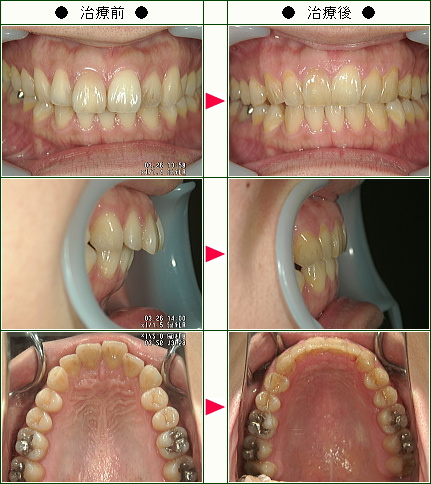 出っ歯矯正症例(Ｉ様　３１歳　女性)