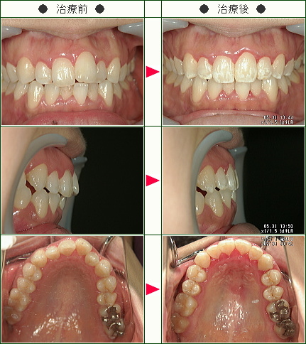 歯のデコボコ矯正症例(Ｉ様　３２歳　女性)