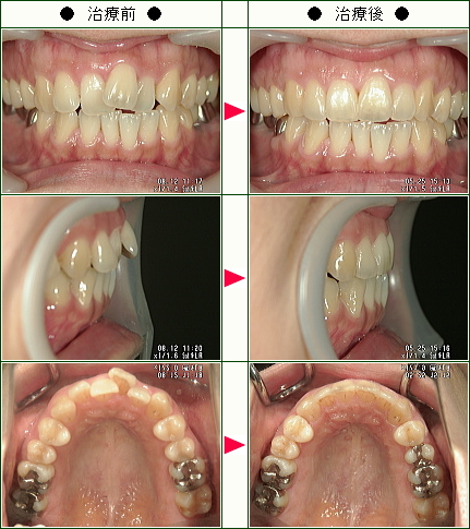 歯のデコボコ矯正症例(Ｉ様　３８歳　女性)